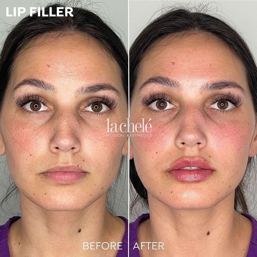 lip filler before and after