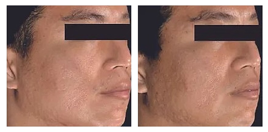 Profile comparison of a person's face.