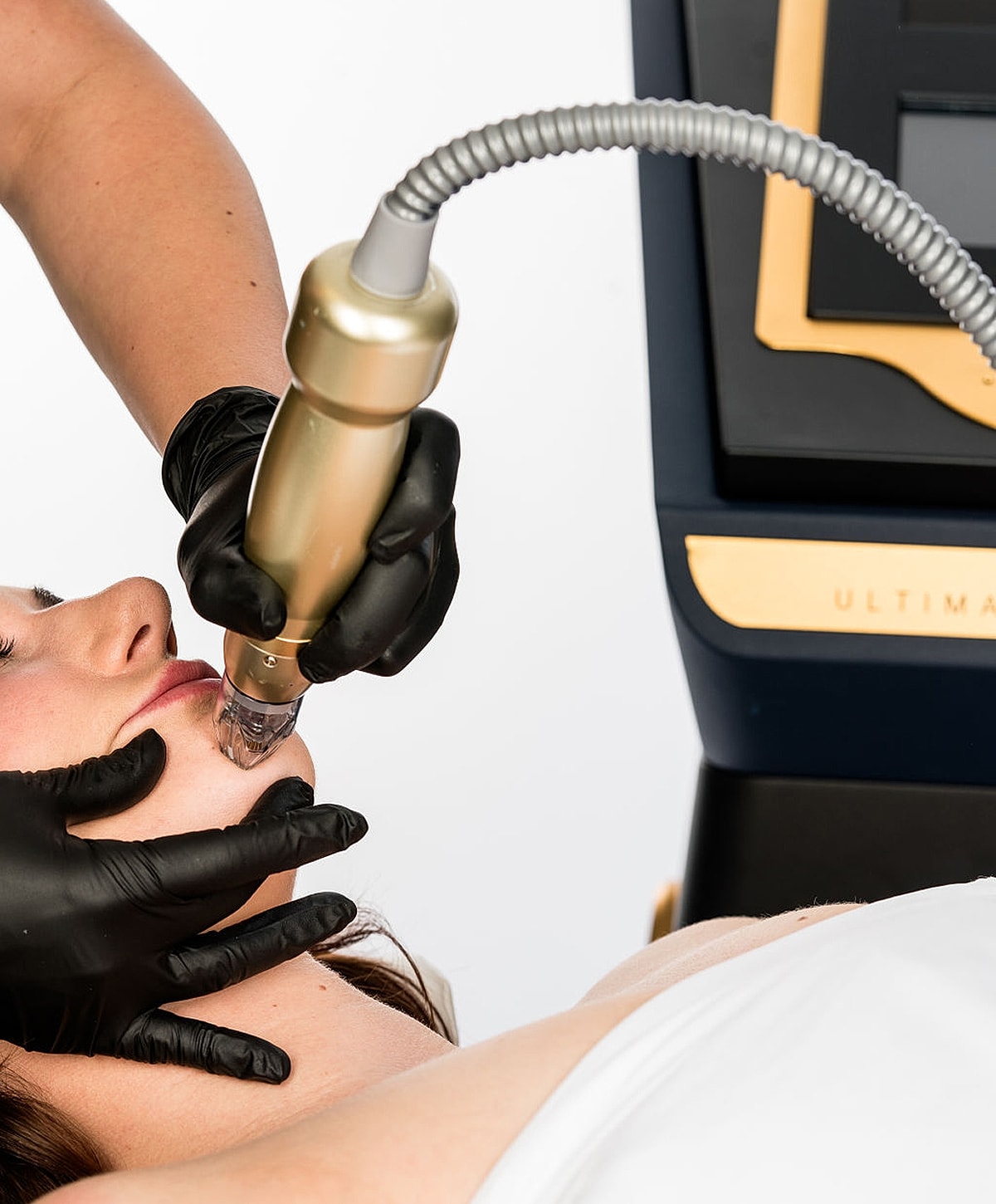 Facial treatment using a microneedling device.