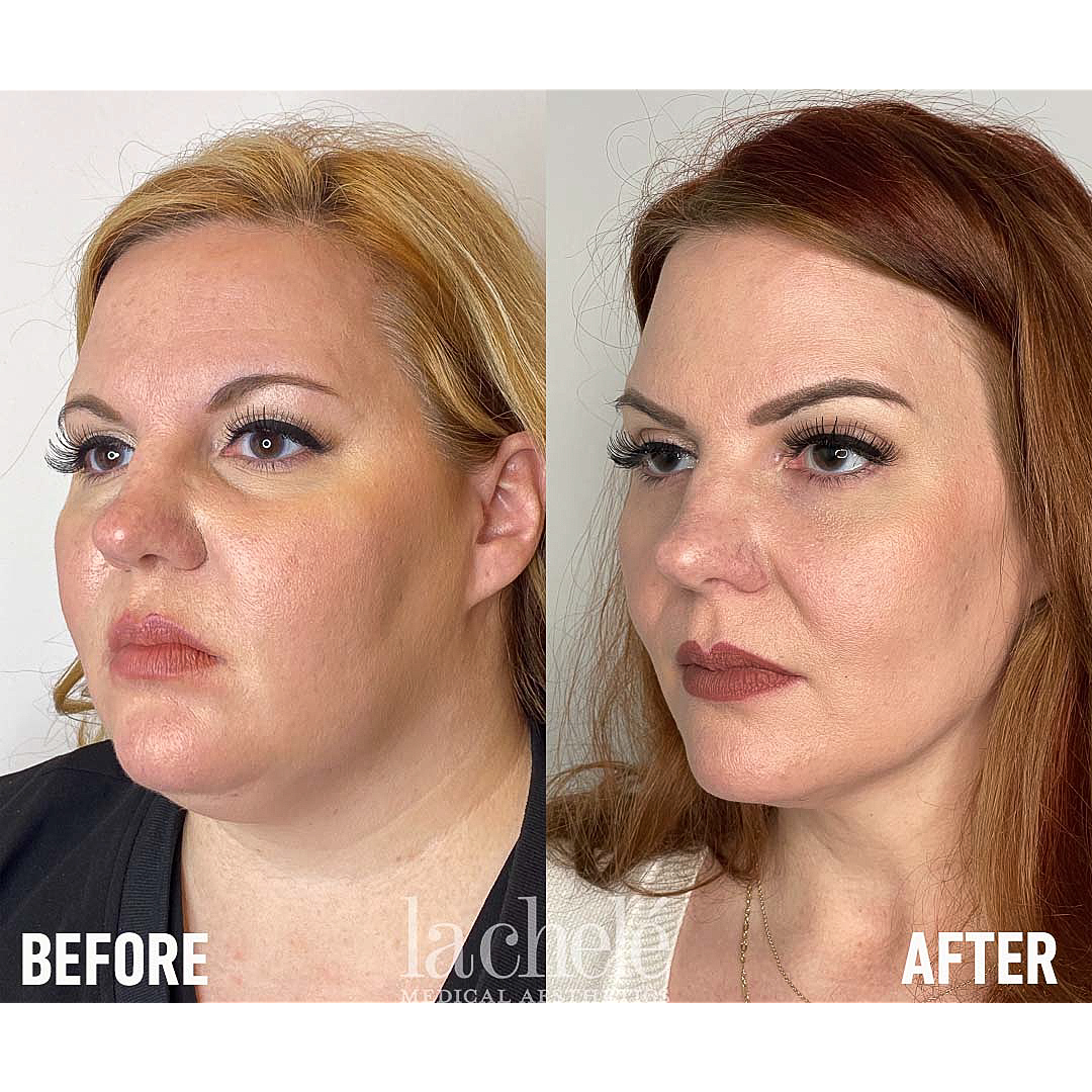 Ozempic for weight loss before and after