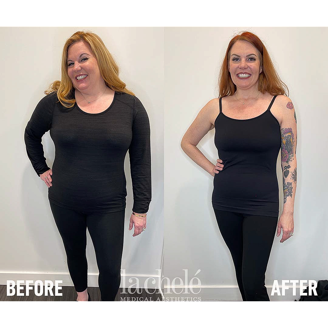Ozempic for weight loss before and after