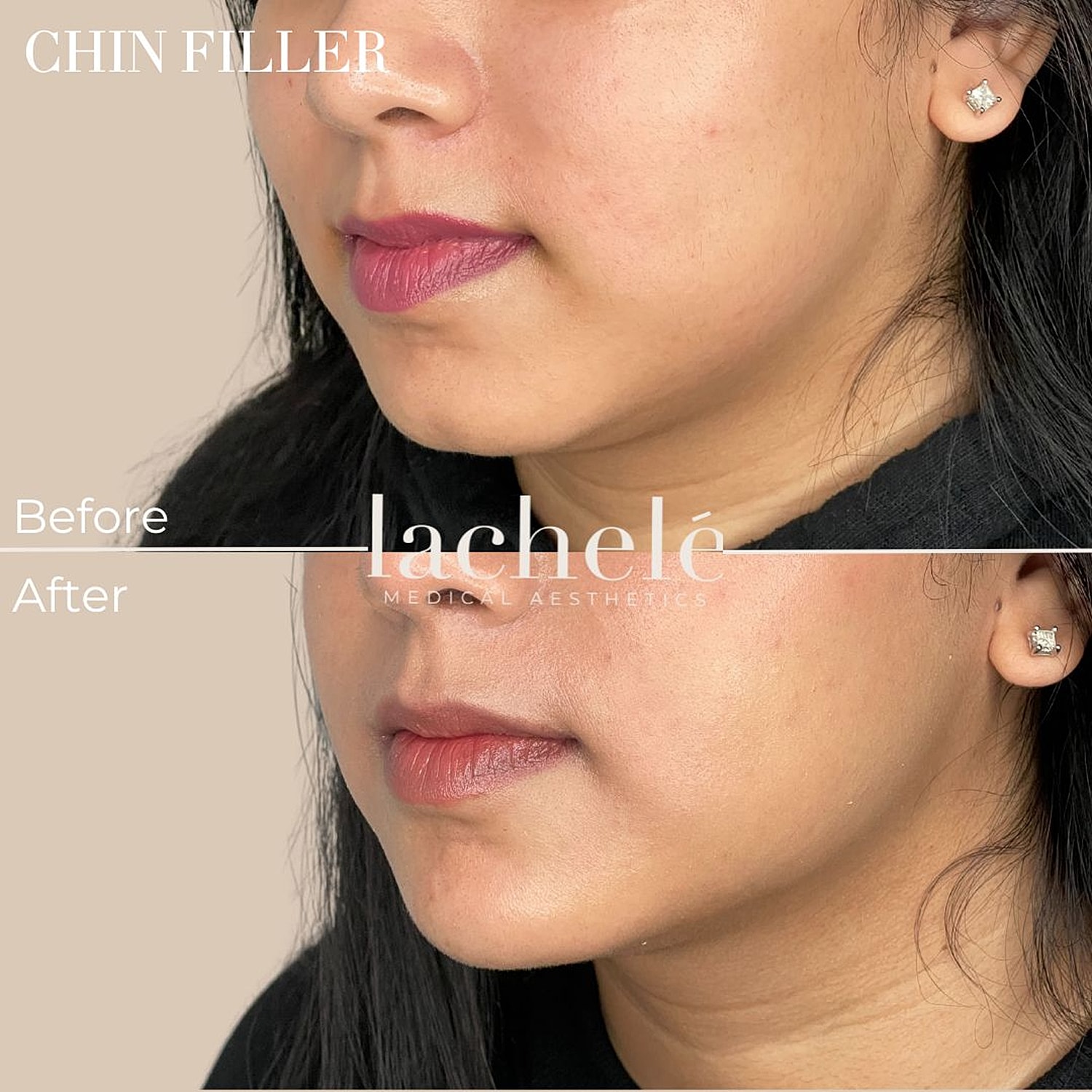 Chin filler before and after results comparison.
