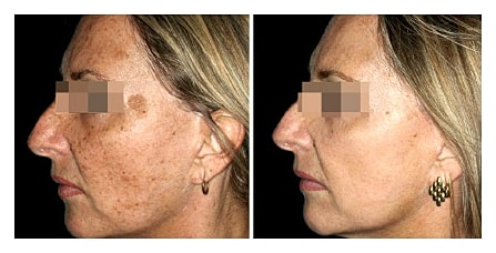 Before and after facial skin treatment comparison.