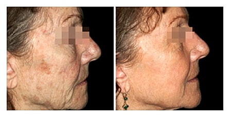 Before and after skin treatment comparison photo.