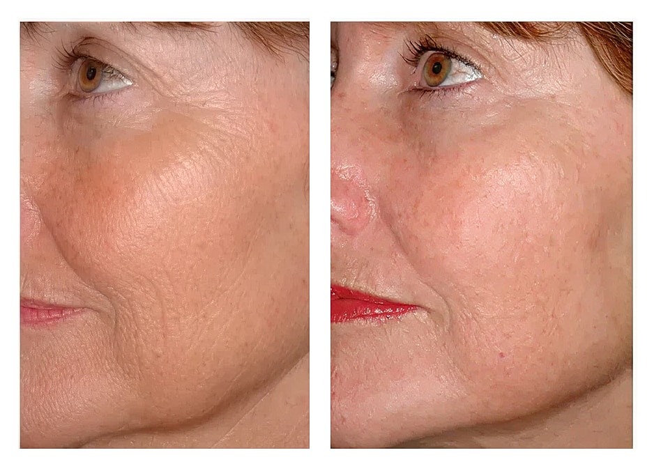 Before and after skin treatment comparison photo.