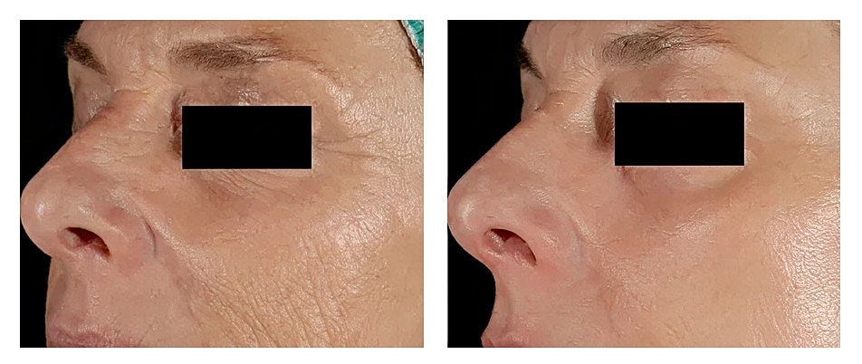 Before and after skin treatment comparison.