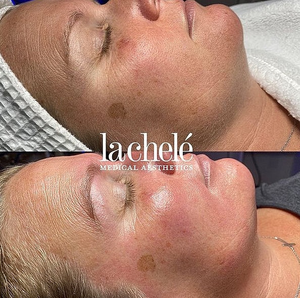 Before and after skin treatment results comparison.