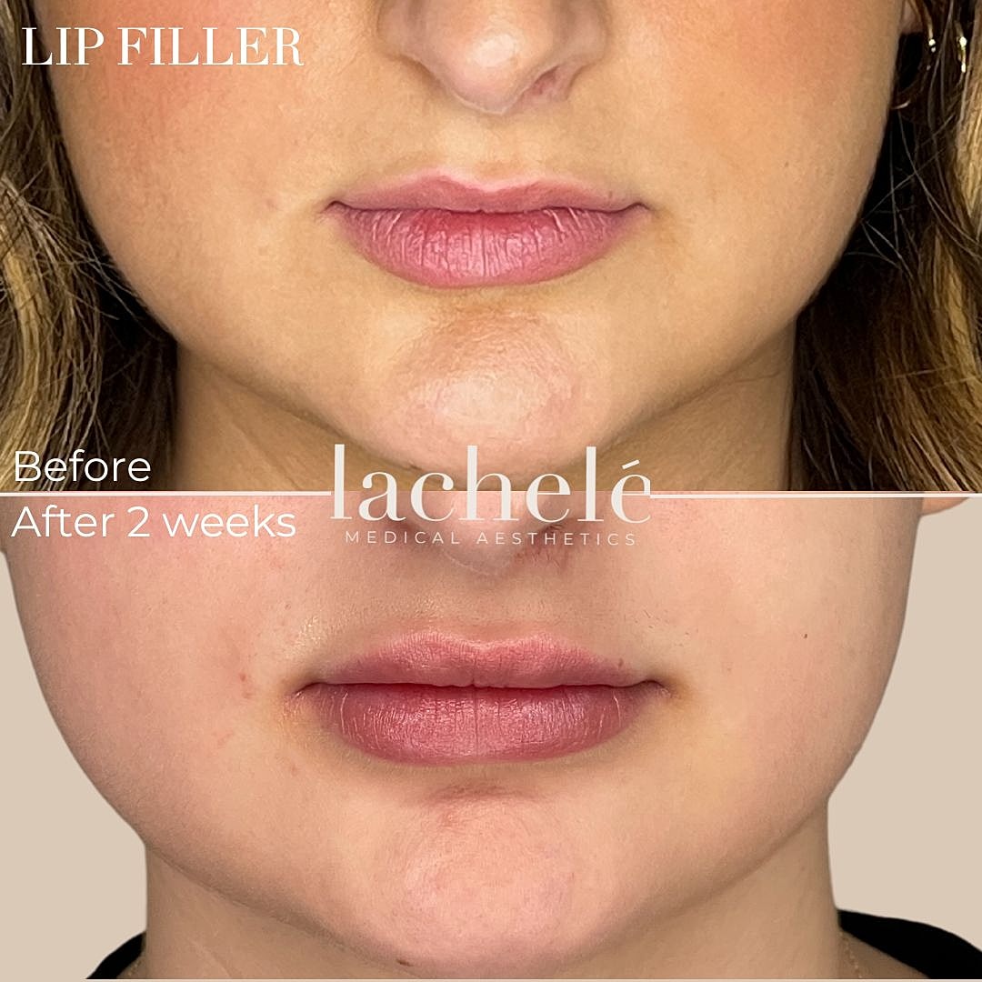 Lip filler results: before and after two weeks.