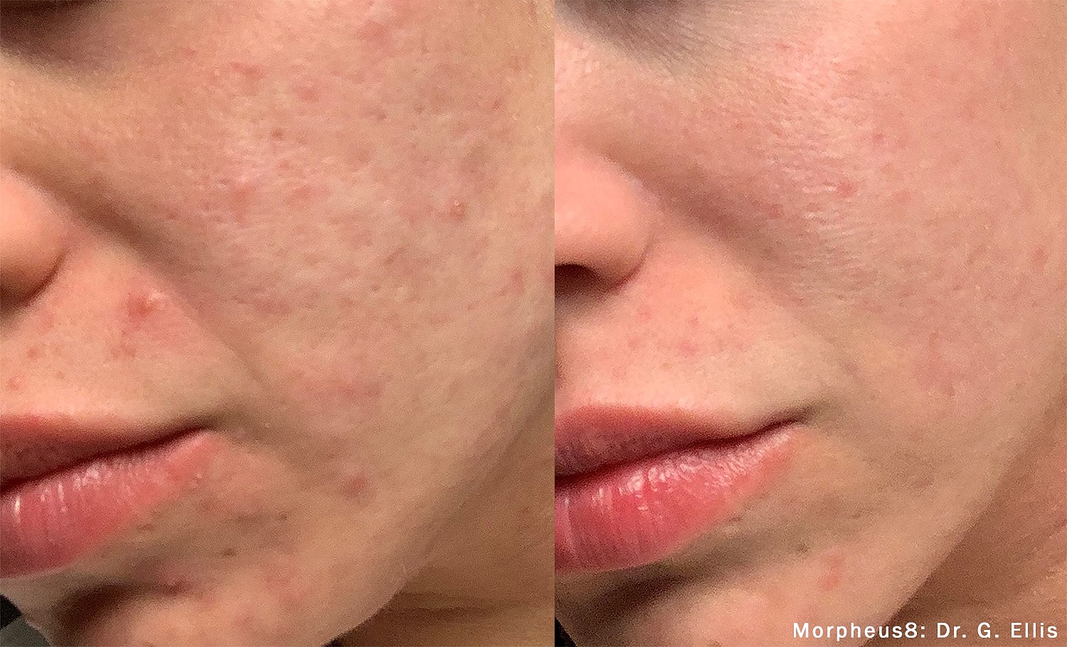 Before and after skin treatment comparison.