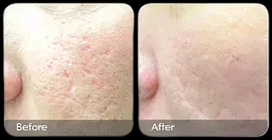 Skin transformation, before and after treatment.