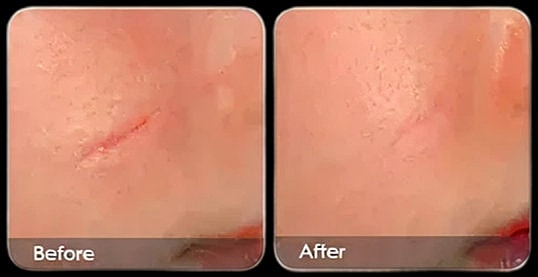 Skin treatment results: before and after comparison.