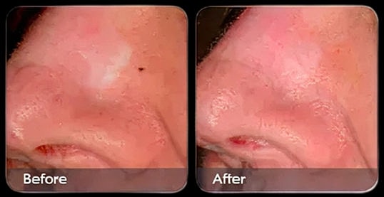 Skin treatment results before and after.
