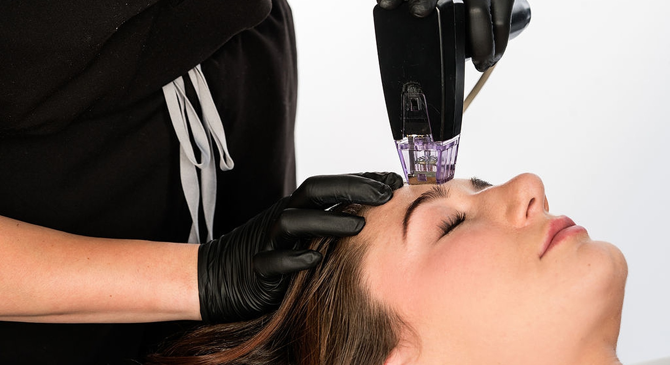 Microneedling treatment on a woman's forehead.