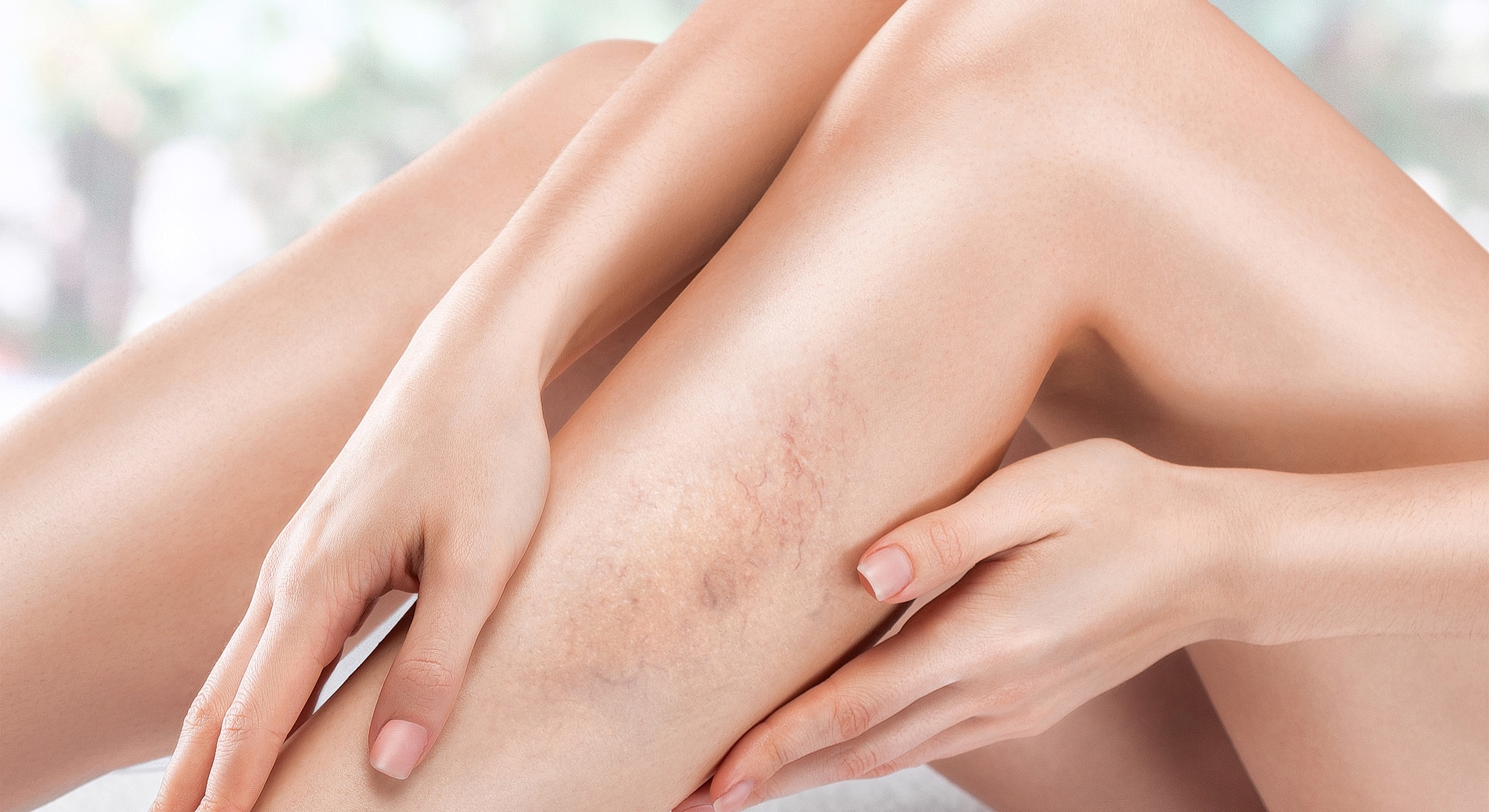 Close-up of legs showing skin imperfections.